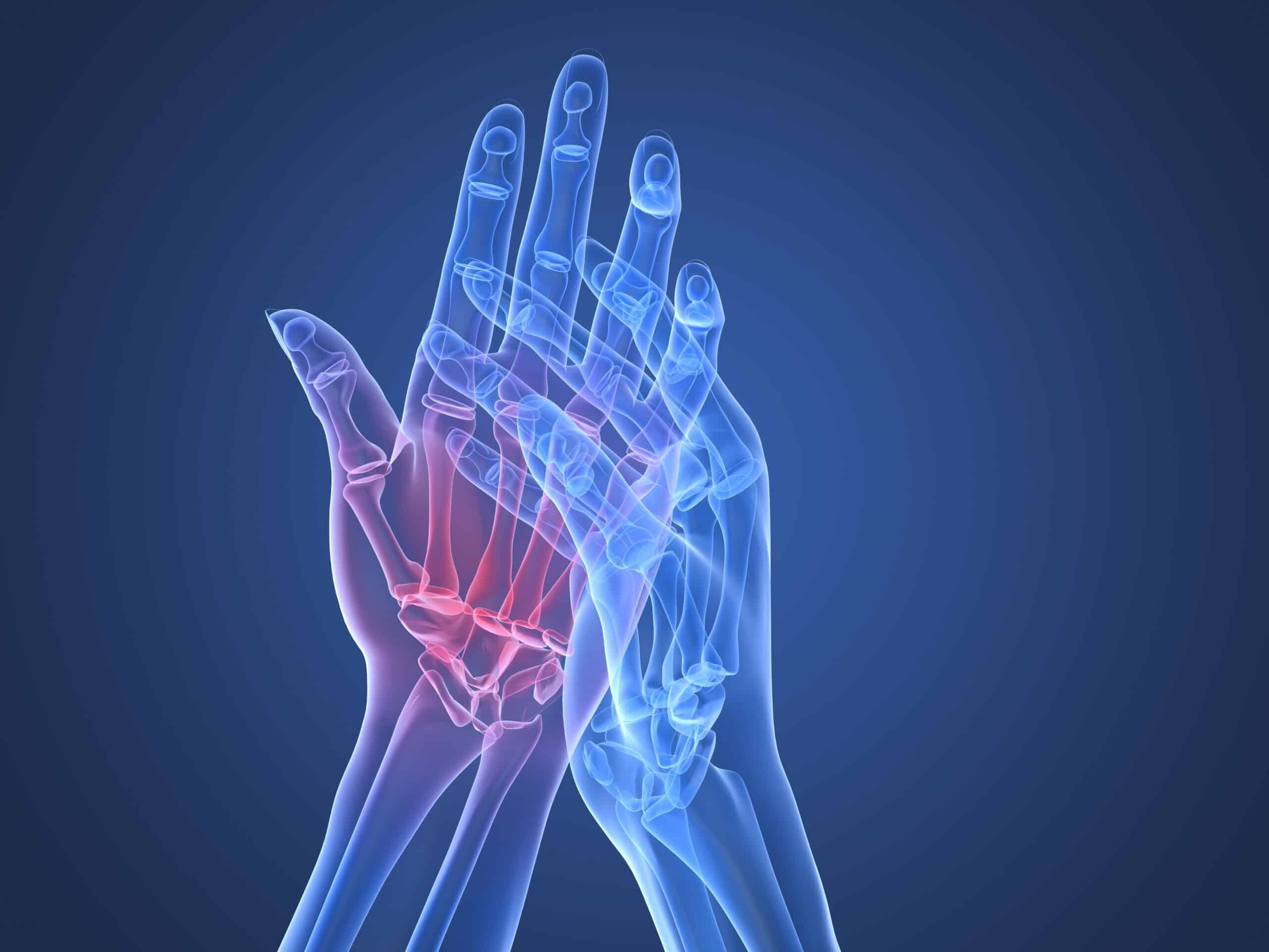 Entzündliche Arthritis